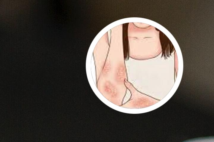 牛皮癣新药治好了吗