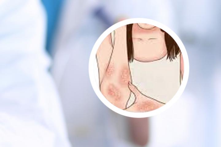得了牛皮癣银屑病怎么治