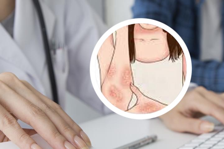 银屑病能吃鲤鱼吗
