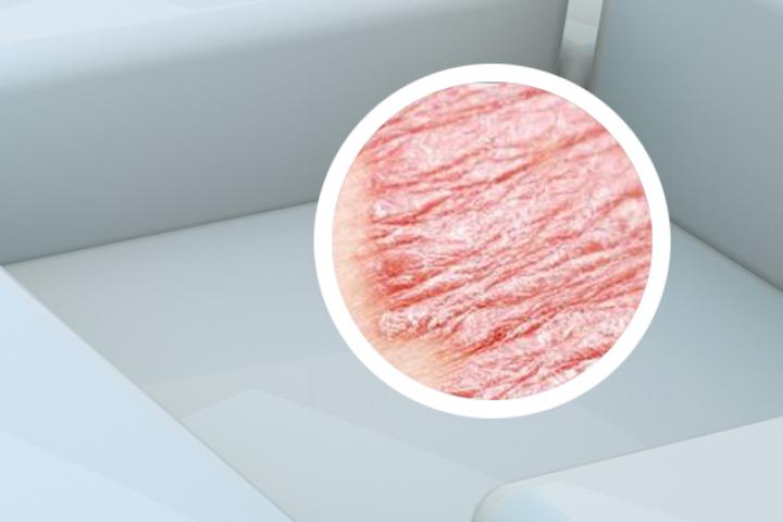 银屑病者不得癌