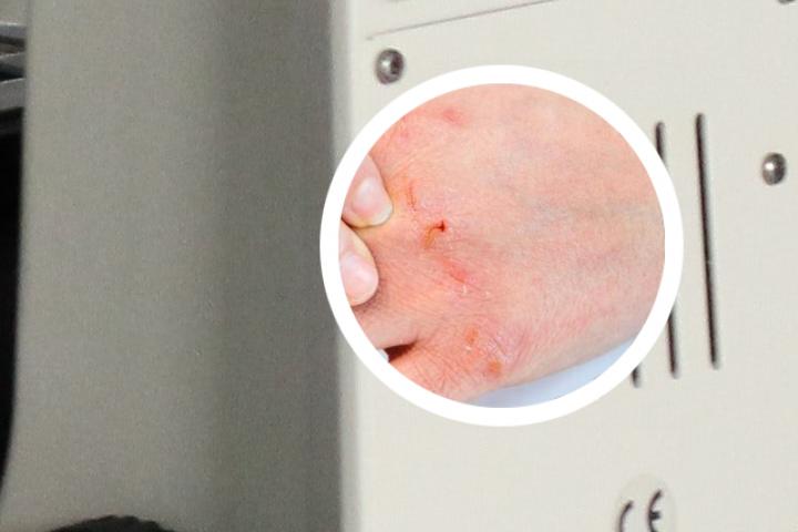 牛皮癣满腿都是怎么办
