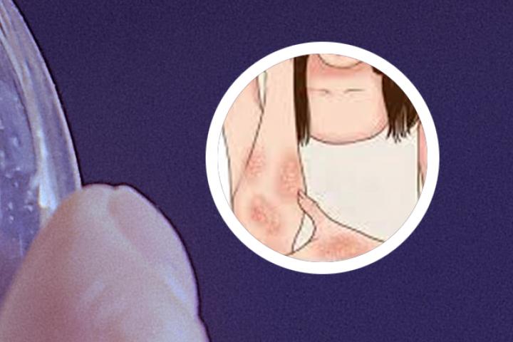 银屑病润肤抹什么药膏