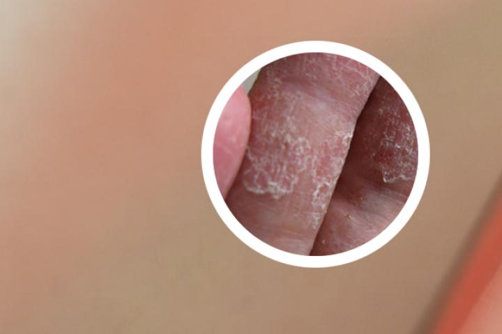 牛皮癣用药小腿浮肿