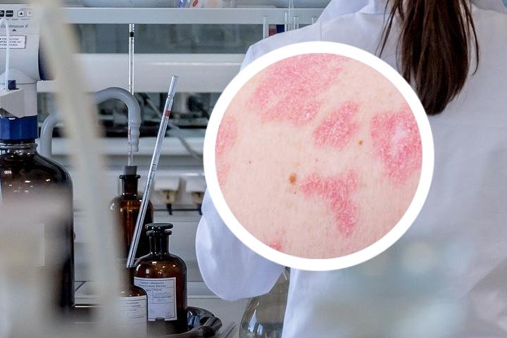 消银片治银屑病论文