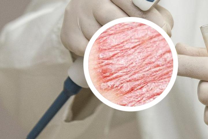 牛皮癣长肉里怎么办