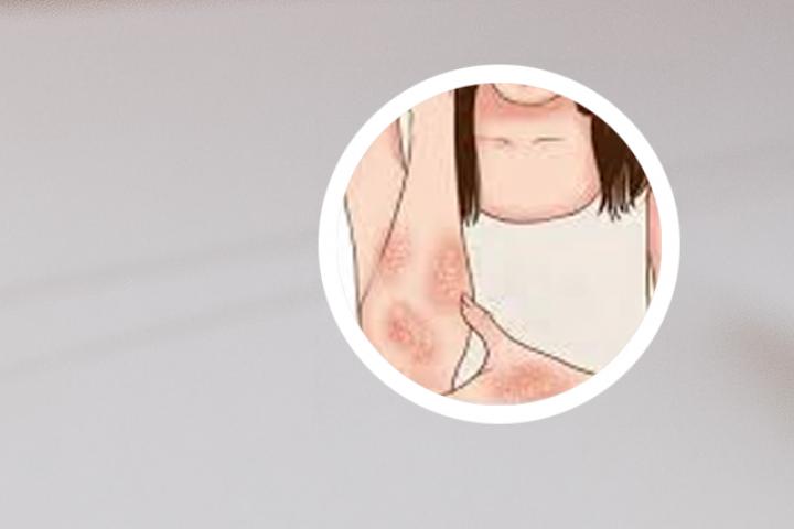 牛皮癣全身激素压制