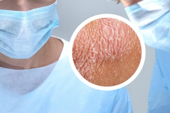 银屑病医院处方