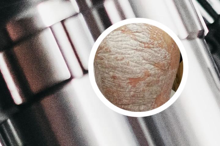 复方银屑病