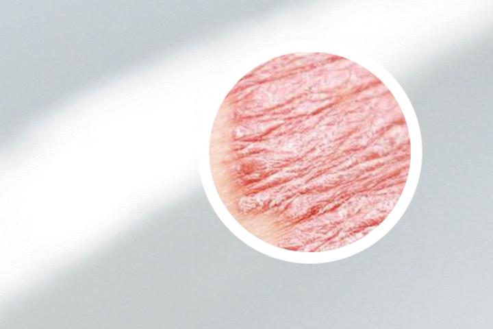 银屑病牛皮画
