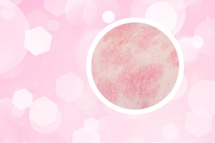 eva导致银屑病