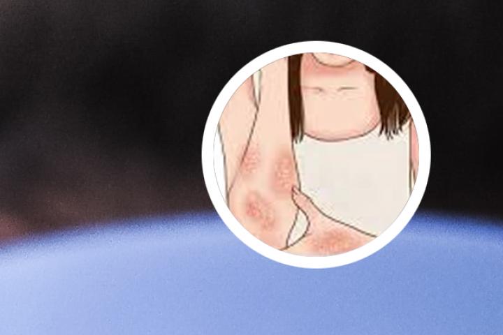 牛皮癣和什么皮肤病类似