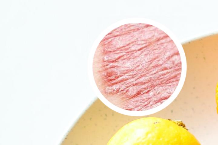 银屑病造模成功标志