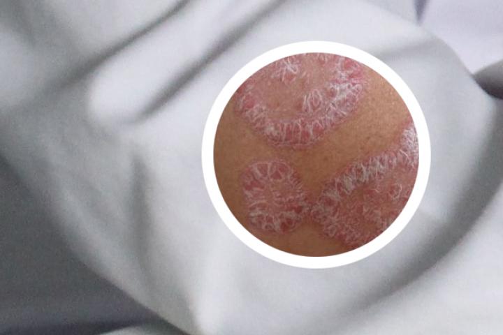 看牛皮癣廊坊怎么样
