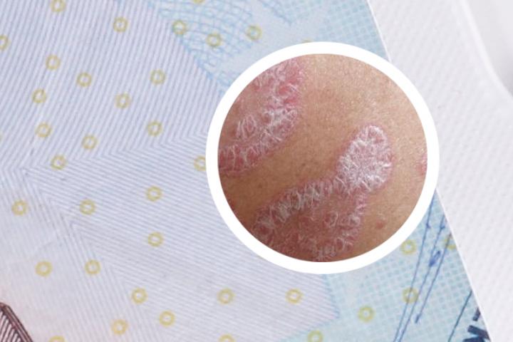 牛皮癣指甲用什么药膏