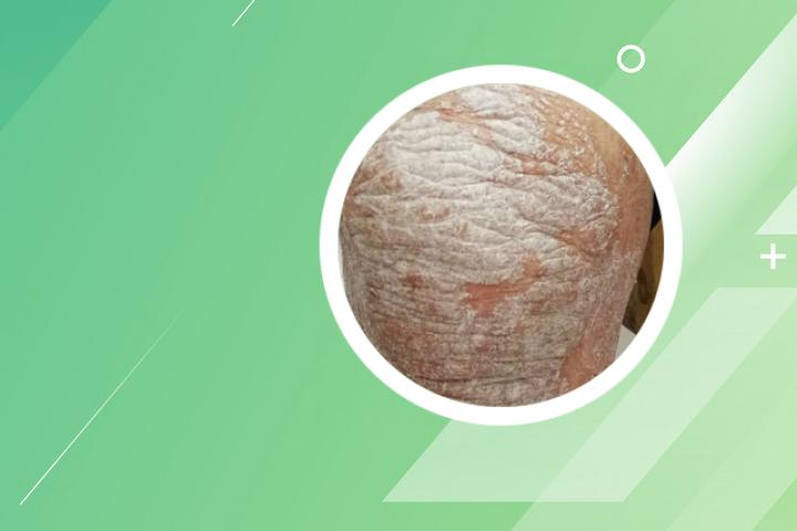 银屑病皮肤干燥怎么护理