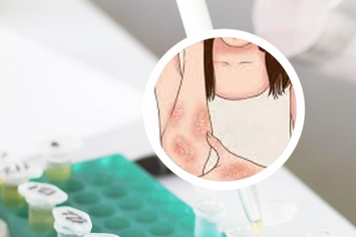 牛皮癣是怎么脱皮的