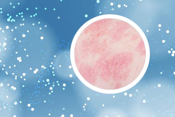 牛皮癣头部保湿去屑