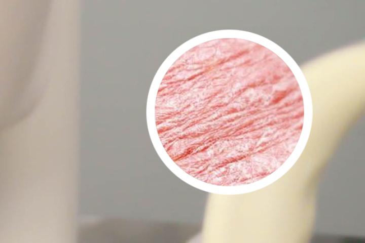 银屑病光疗需要多久