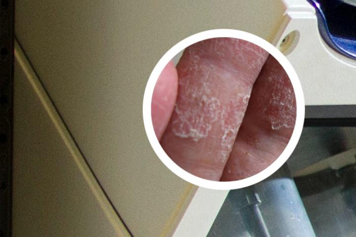 特殊型牛皮癣治疗要点