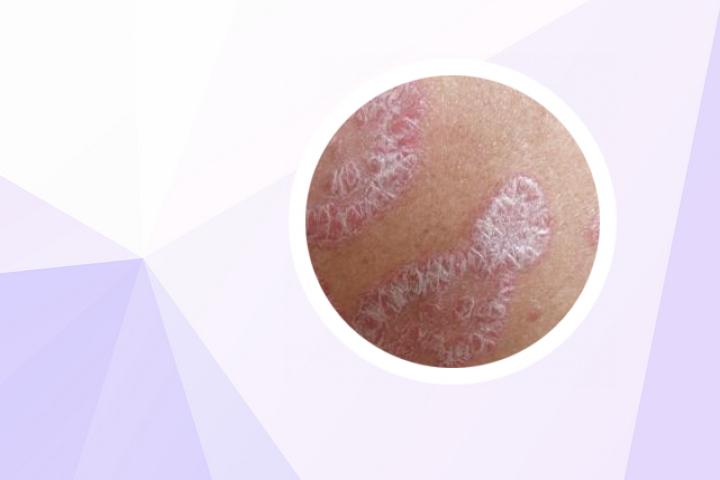 本维莫德乳膏能治牛皮癣