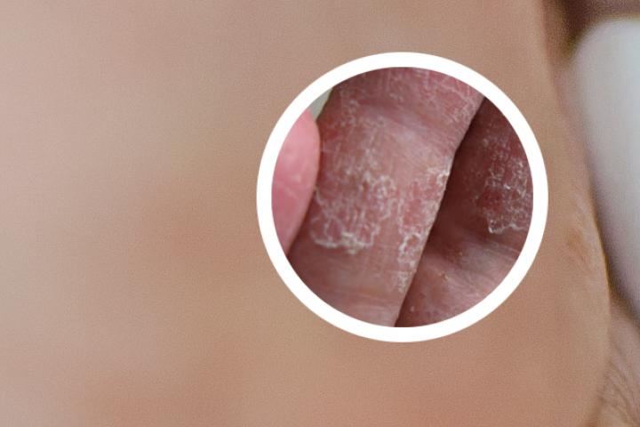 牛皮癣输什么液体比较好