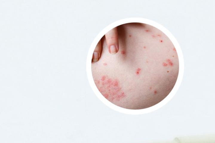 腿部银屑病图片女性症状