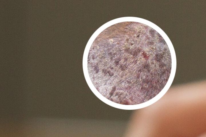 西安治疗牛皮癣哪家