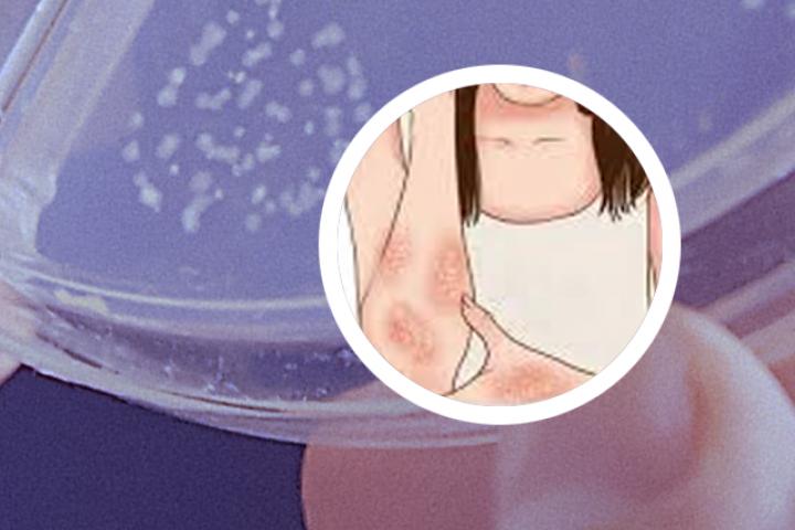 牛皮癣能用开水烫不