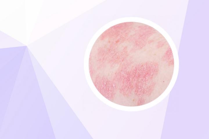 槐花加上什么治牛皮癣