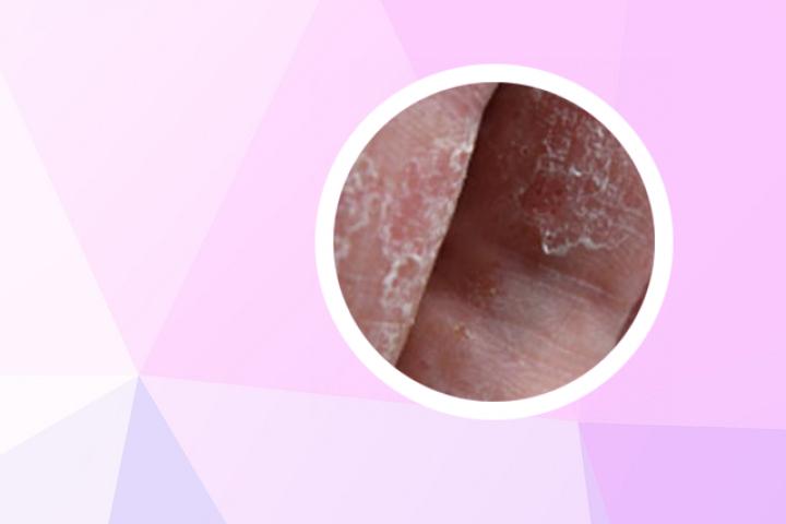 双氧水治疗牛皮癣可行吗