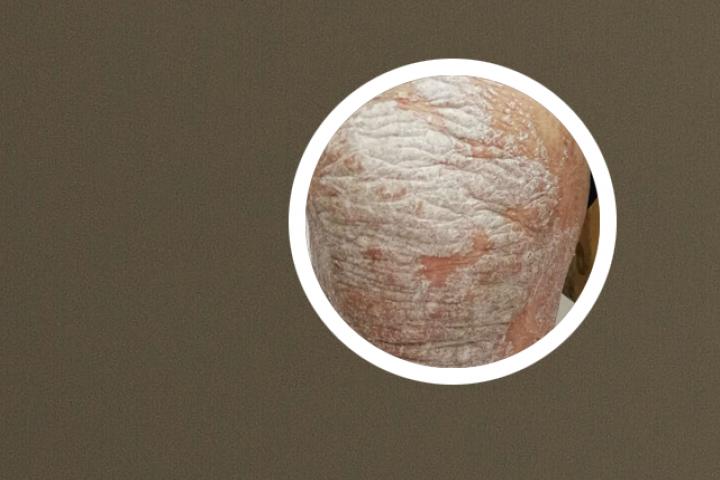 环磷腺苷针治疗牛皮癣