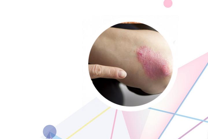 银屑病晚期还能治好吗