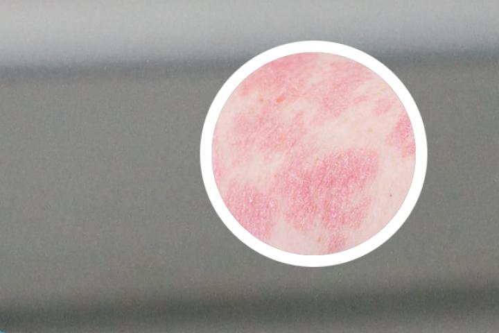 点滴状银屑病是缺啥