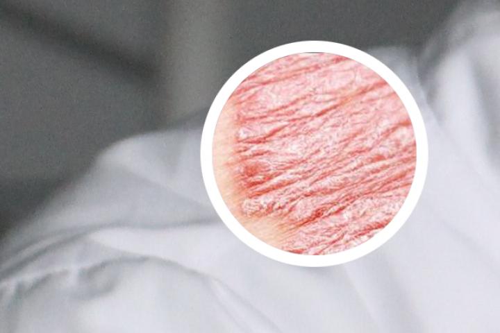 谁用过生物剂治疗牛皮癣