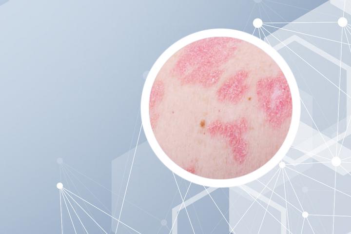 银屑病大量掉皮还痒