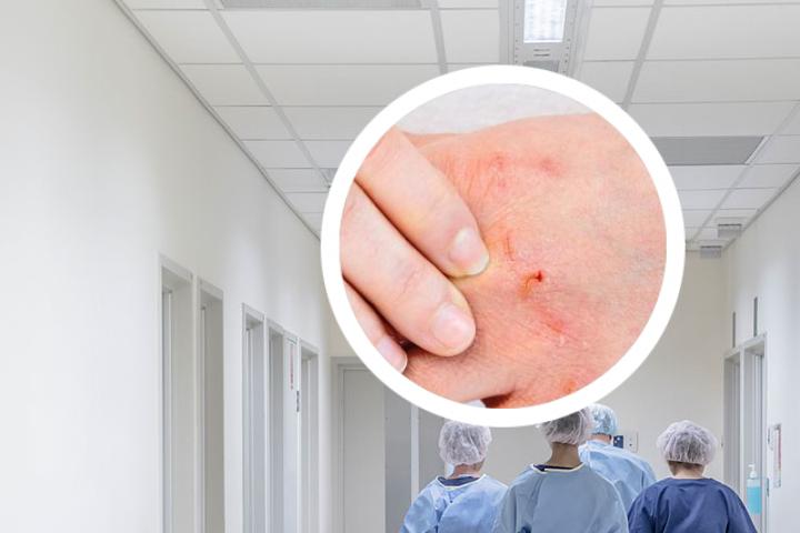 健身流汗银屑病