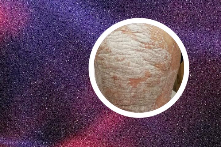 南京皮炎所治牛皮癣药膏