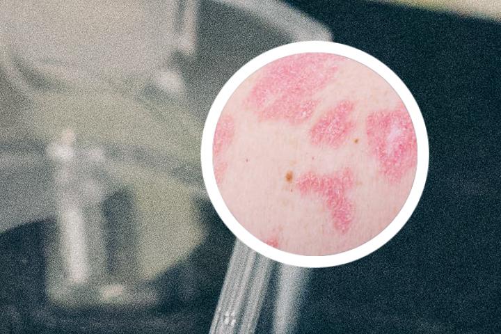 牛皮癣是病在皮肤还是内脏