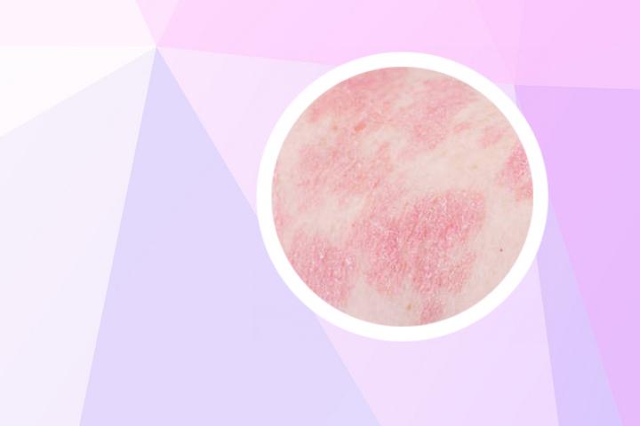 在家怎么治疗银屑病