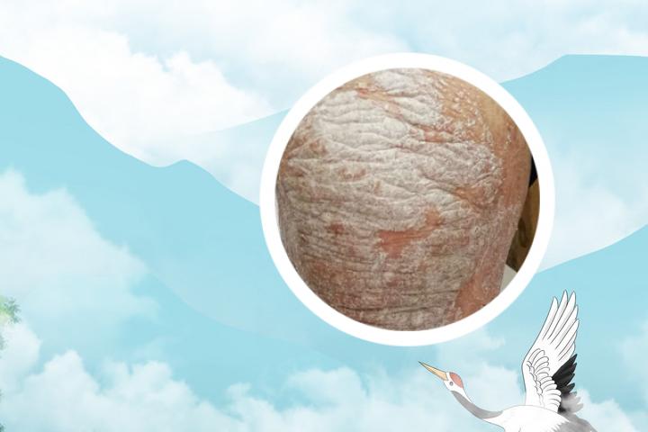 空军总院牛皮癣套装