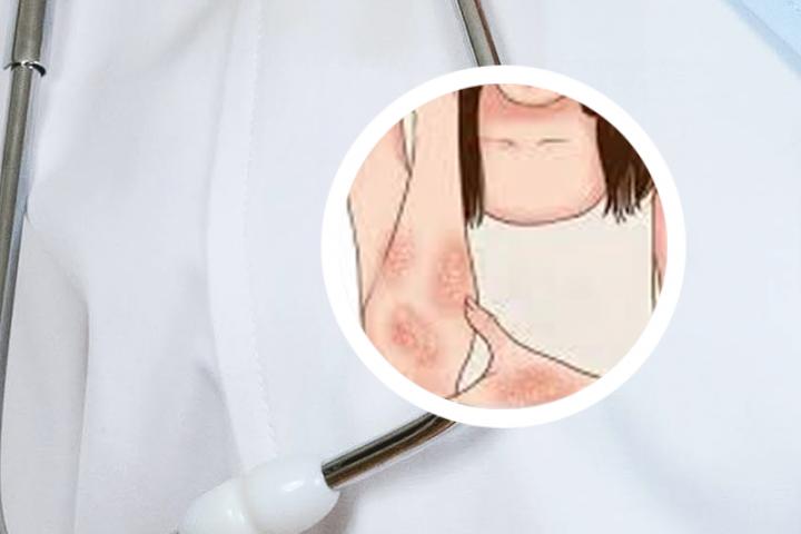 点滴型牛皮癣喝中药爆发