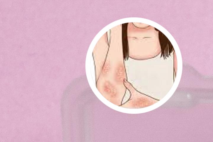 丝瓜水能治疗牛皮癣吗