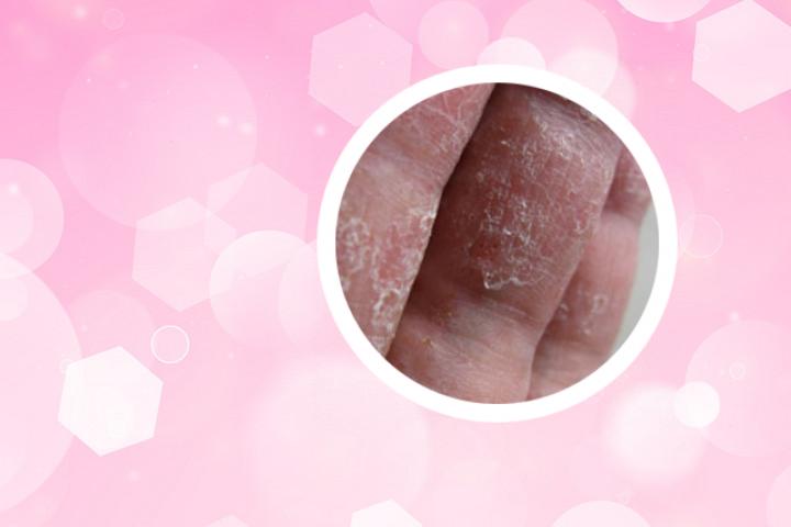辽阳银屑病怎么治疗