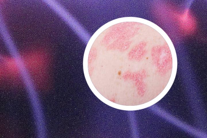 银屑病抵抗力治疗