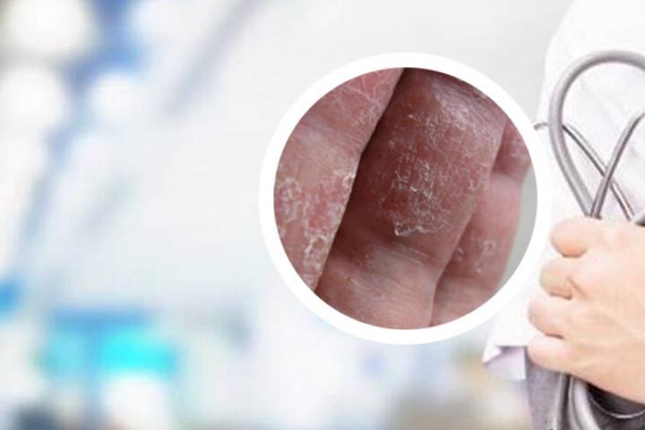 红皮病型银屑病用什么泡澡