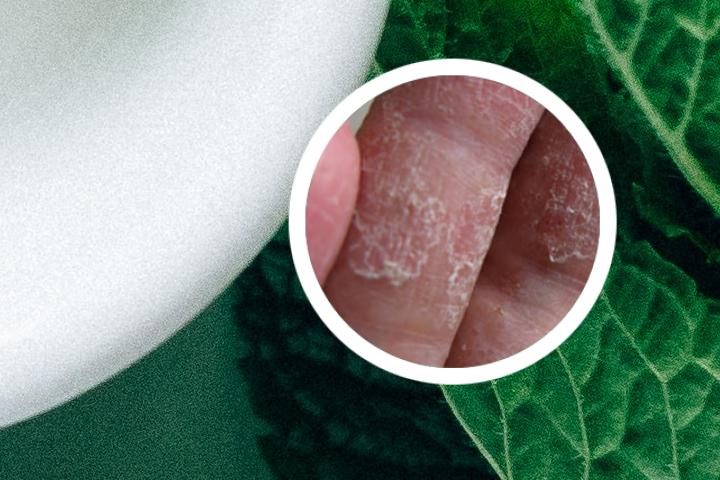 牛皮癣全身点状