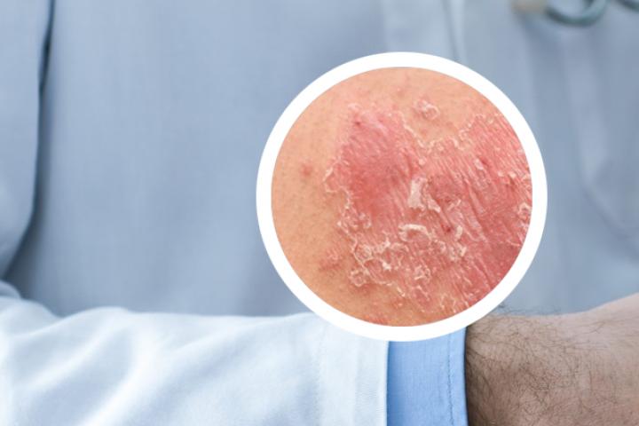银屑病能压腿么