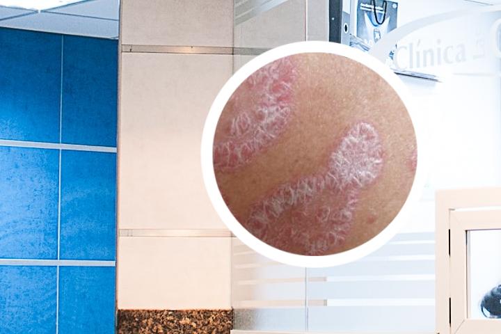 烟台银屑病补助在哪里申报
