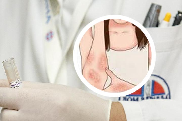 出汗治银屑病