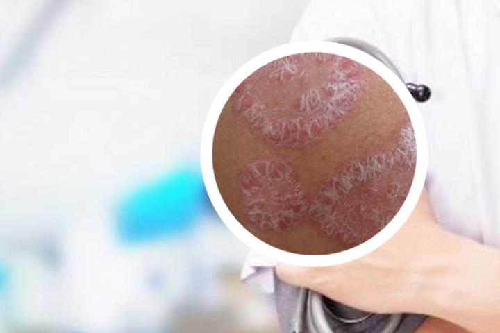 日本银屑病治疗术